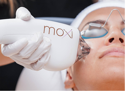 Laser Resurfacing