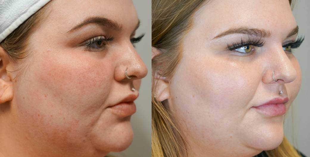 Revive Radiance Laser 
