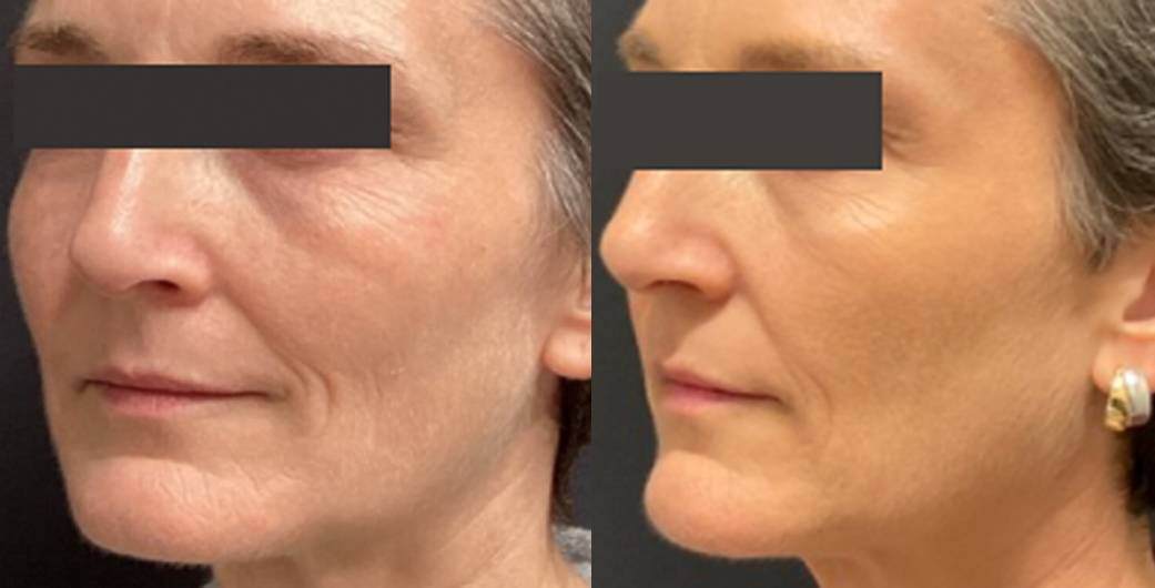 Revive Radiance Laser 