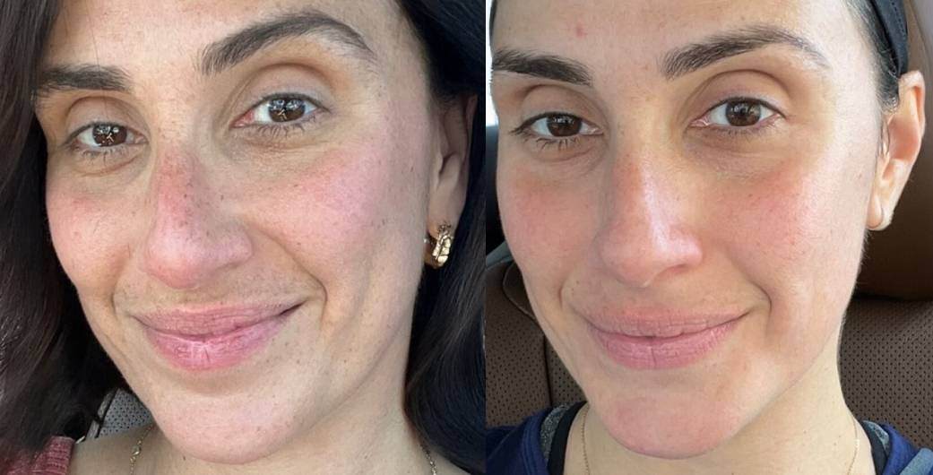 Revive Radiance Laser 
